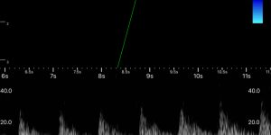 Finger peripheral vessel