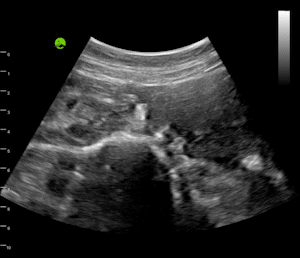Polycystic ovarian syndrome with follicles