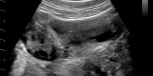 Polycystic ovary syndrome with follicles